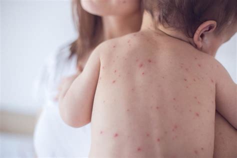 Measles, Mumps, Rubella: What is the MMR Vaccine?