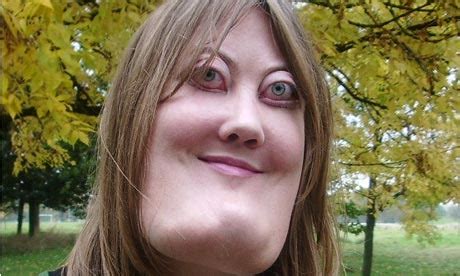 Media dis&dat: British woman with facial disfigurement ...