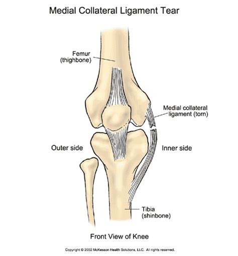 Medial collateral ligament  MCL  of the knee. Causes ...