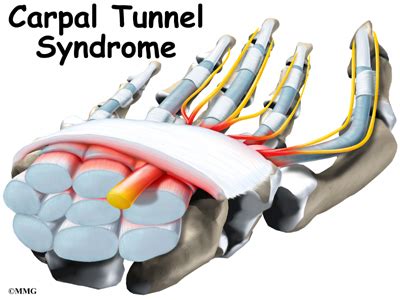 Median Nerve: Carpal Tunnel Syndrome | Houston Methodist