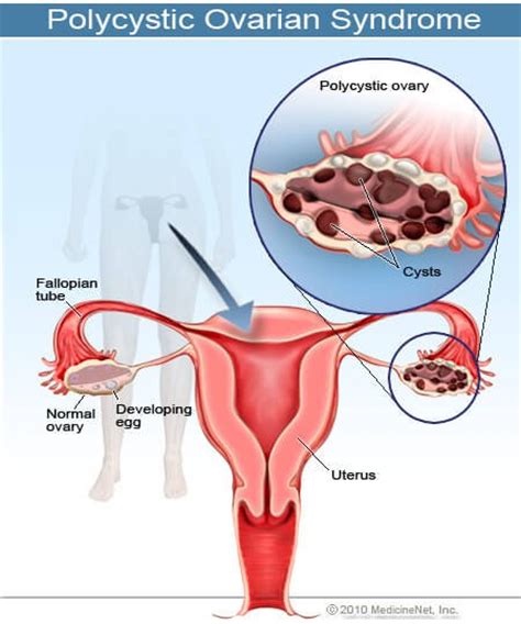 Medical Definition of Polycystic ovarian syndrome