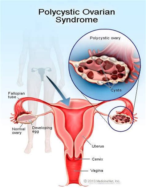 Medical Definition of Polycystic ovary syndrome