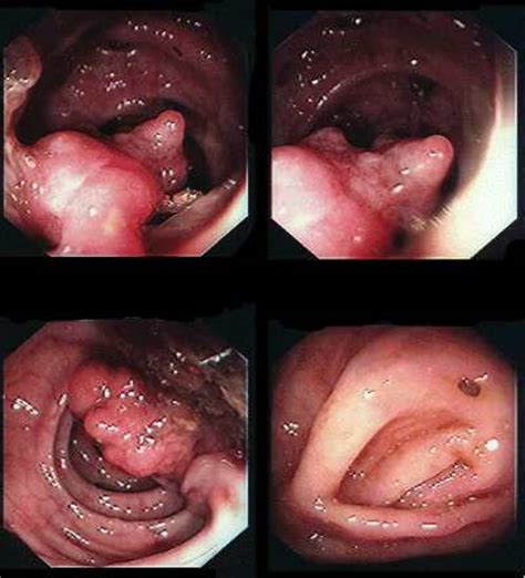 Medical Pictures Info – Colon Polyps