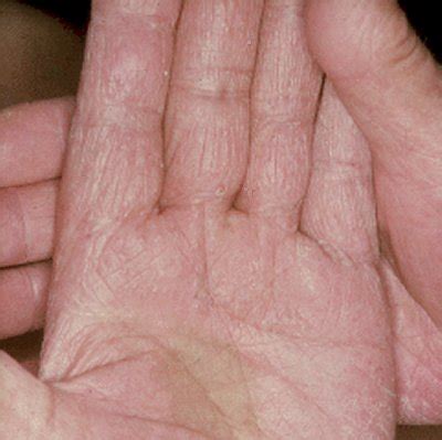 Medical Pictures Info – Fungal Skin Infection