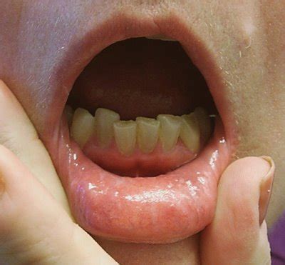 Medical Pictures Info – Lip and Mouth Cancer