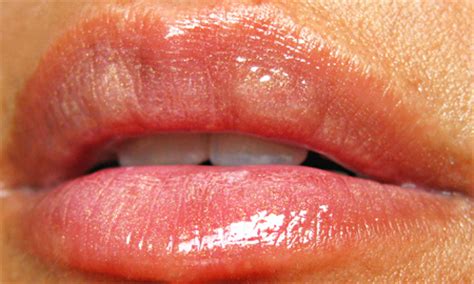 Medical Pictures Info – Lip Cancer