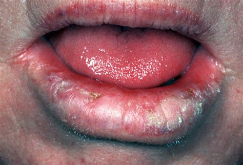 Medical Pictures Info – Lip Cancer