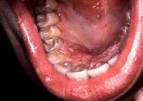 Medical Pictures Info – Mouth Cancer