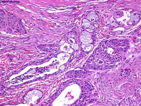 Medical Pictures Info – Mucoepidermoid Carcinoma