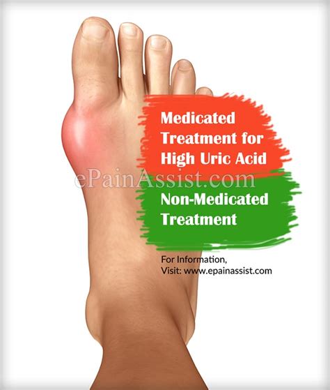 Medicated & Non Medicated Treatments for High Uric Acid
