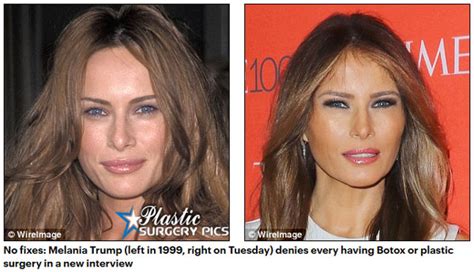 Melania Trump Plastic Surgery Pictures 2018