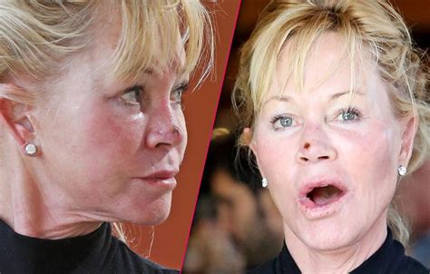 Melanie Griffith Steps Out With Scab On Her Nose