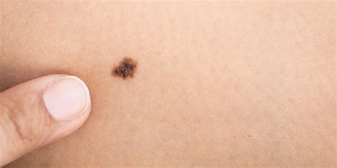 Melanoma and the Importance of Performing Skin Checks ...