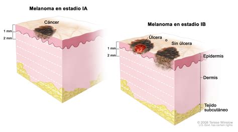 Melanoma maligno   Clínica Dermatológica y Estética en ...