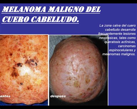 Melanoma maligno del cuero cabelludo – PIEL L Latinoamericana
