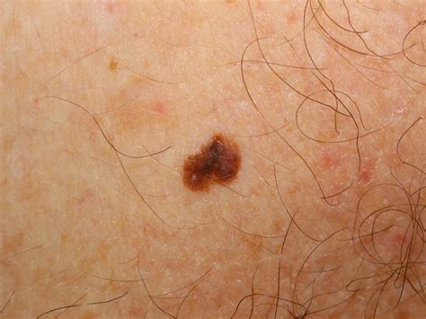 Melanoma Pictures Stage 1 Pictures to Pin on Pinterest ...