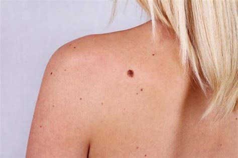 Melanoma skin cancer: What moles to look out for | The ...