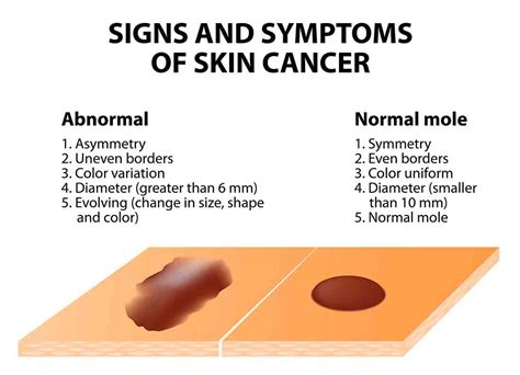 Melanoma: The Scary Link Between Diet and Skin Cancer
