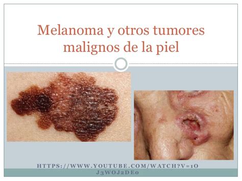 Melanoma y otros tumores malignos de la piel
