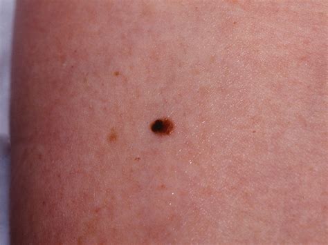 melanomas in situ   pictures, photos