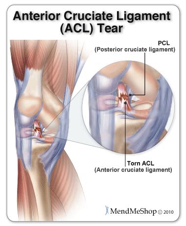 MendMyKnee.com   All about the Anterior Cruciate Ligament ...