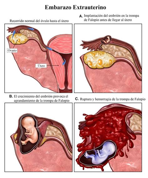 Menstruación durante el embarazo, píldora, normal, posible ...