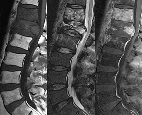 Metastases  renal cell, lumbar  — Clinical MRI