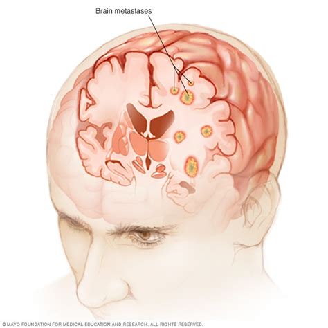Metástasis cerebral   Síntomas y causas   Mayo Clinic