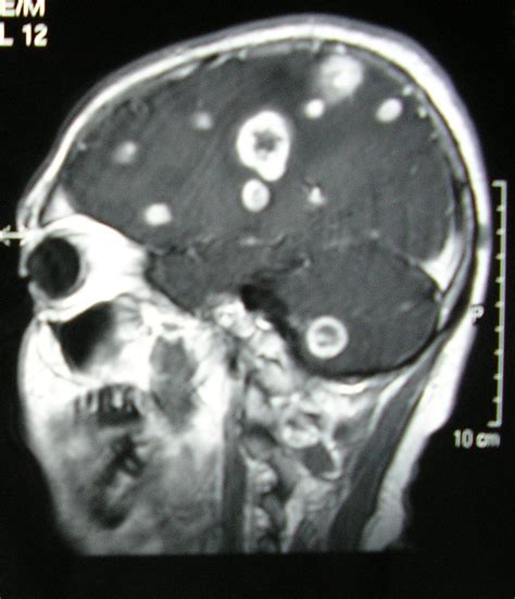 metastasis cerebrales   biosciences.uphero.com