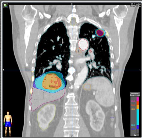 Metástasis hepáticas y pulmonares — Radioterapia HM