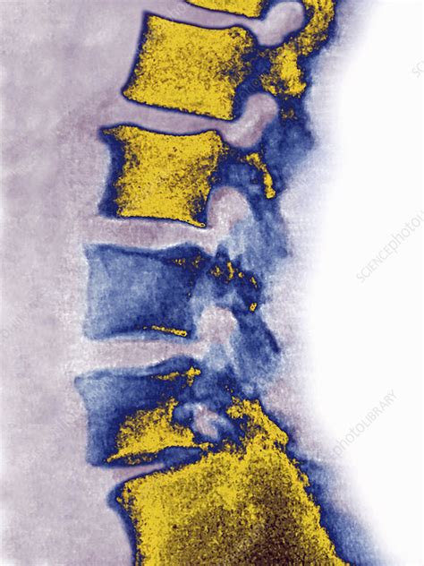 Metastasis, Lumbar Vertebrae   Stock Image C021/3902 ...