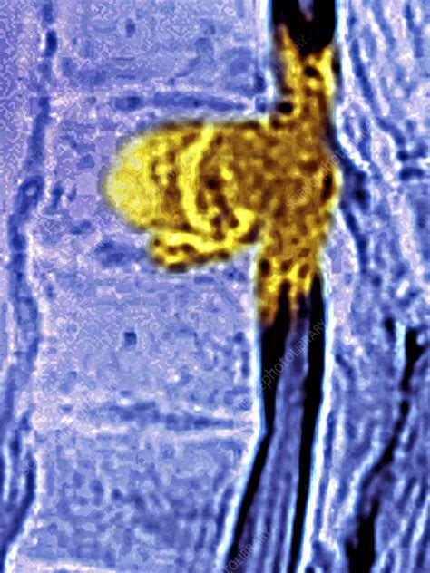 Metastasis, Lumbar Vertebrae   Stock Image C021/3937 ...