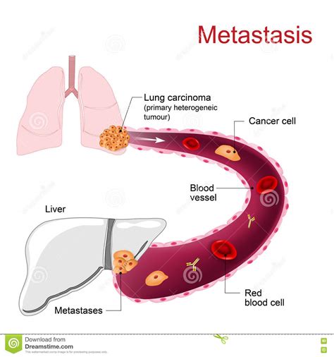 Metastasis. Metastases stock vector. Image of anatomy ...