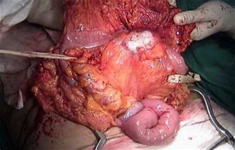 Metastasis of Renal Carcinoma to the ascending colon  6 of ...