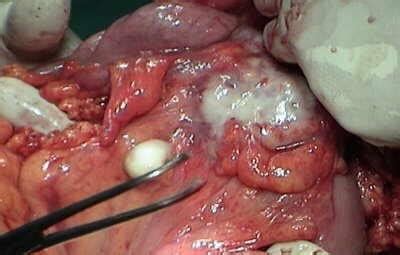 Metastasis of Renal Carcinoma to the ascending colon  8 of ...
