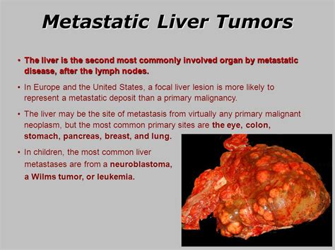 Metastatic breast cancer to liver prognosis