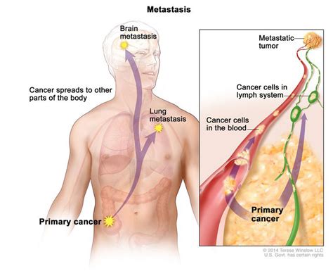 Metastatic Cancer   National Cancer Institute
