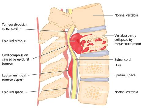 Metastatic Epidural Spinal Cord Compression and ...