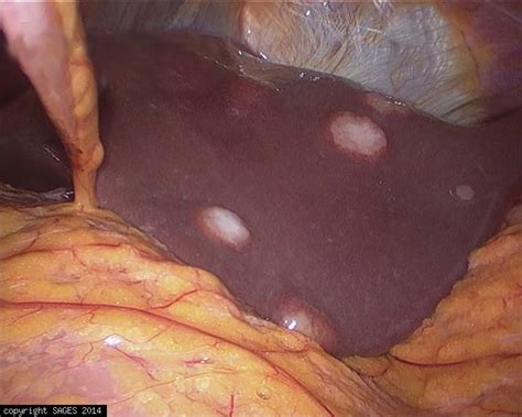Metastatic gastric cancer to the liver  SAGES Image Library