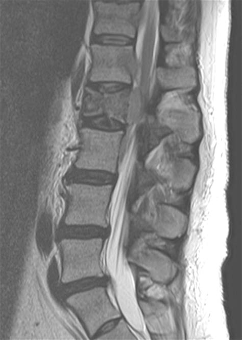 Metastatic Tumor to the Spine: Compression and Instability