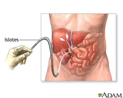 Mi diabetes y mi páncreas.: Trasplante de pancreas