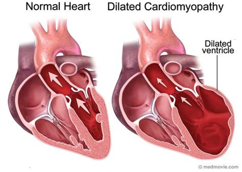 Miocardiopatía alcohólica: la dilatación del corazón ...