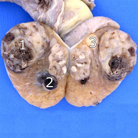Mixed germ cell tumour of the testis: gross pathology ...