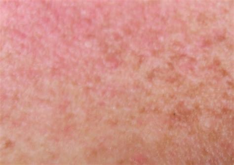 Mono rash   pictures, treatment, duration, symptoms