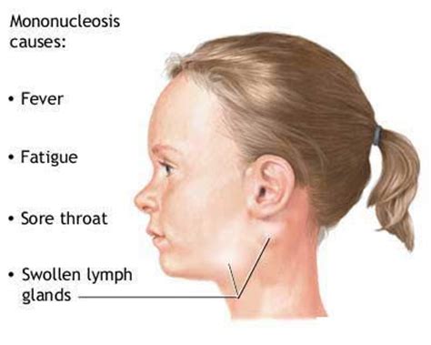 Mononucleosis Symptoms