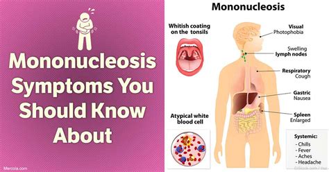 Mononucleosis Symptoms You Should Know About
