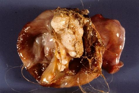 Monstrous tumors from hell – “teratoma” tumors found to ...