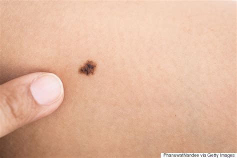 More Than 11 Moles On One Arm Could Indicate  Higher Risk ...