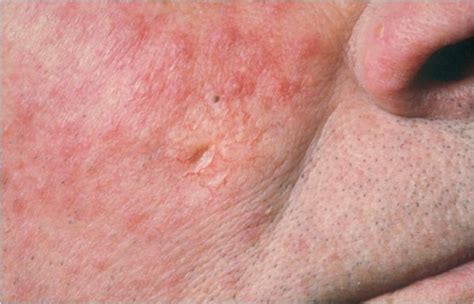 Morpheaform Basal Cell Carcinoma Pictures