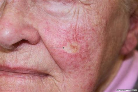 Morphoeic basal cell carcinoma | Primary Care Dermatology ...